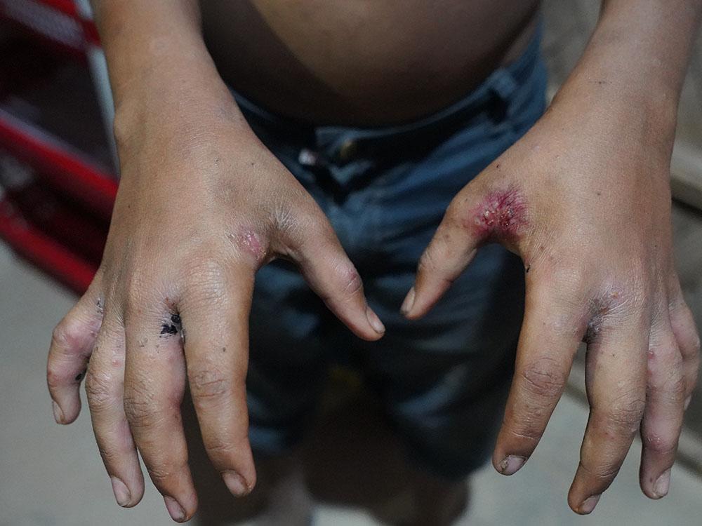 A young child with scabies at MSF’s Hakimpara clinic in Cox’s Bazar, Bangladesh 
