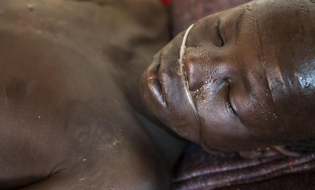 Kume Saadi Kuony survived an explosion and was taken to an MSF managed hospital in Leer, South Sudan. Petterik Wiggers