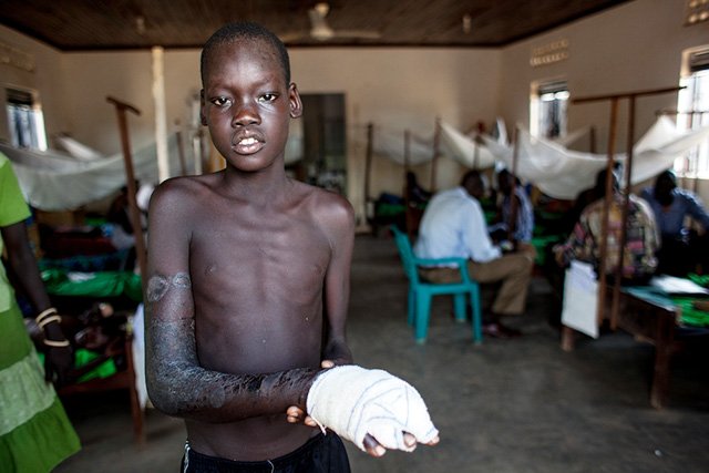 MSF increasingly treats snakebite in its field programmes. This includes 300-400 snakebite victims per year in Paoua, the Central African Republic; and over 300, in Agok, South Sudan in 2014. Many of the victims are children. Photo: Isabel Corthier/MSF