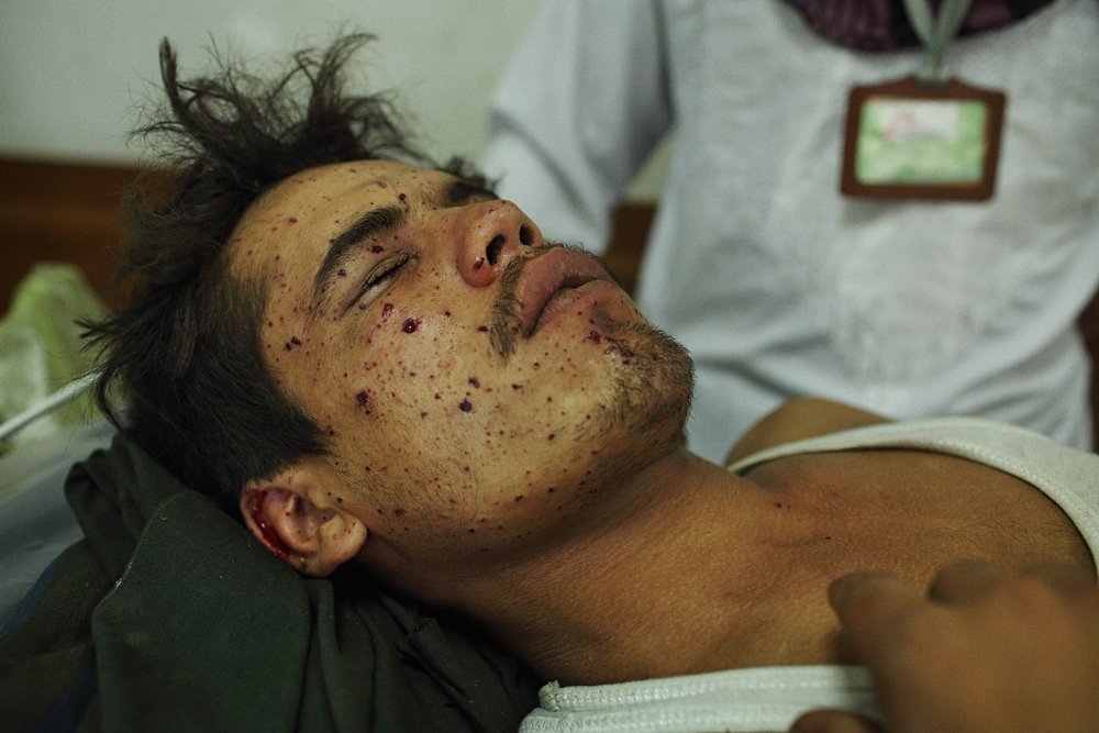 Archive photo (July 2015). young man with facial wounds sustained when a mortar shell landed nearby is has his wounds cleaned and dressed at MSF Kunduz Trauma Centre. Photo: Andrew Quilty / Oculi/Oculi