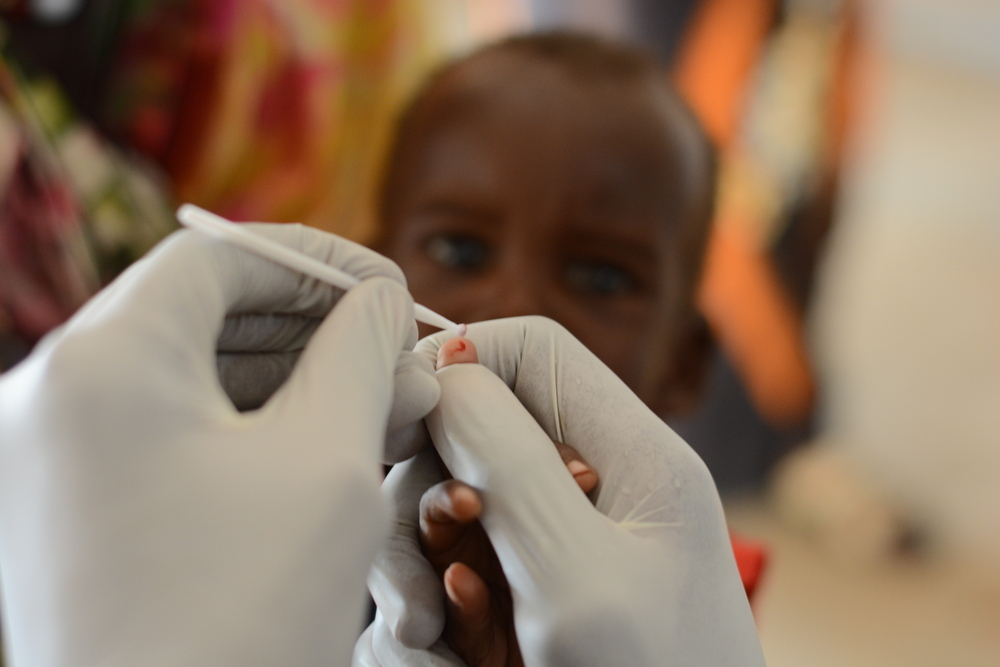 MSF, Doctors Without Borders, Malnutrition in Sudan Zamzam Camp