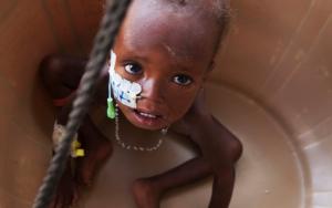 Malnutition in Niger
