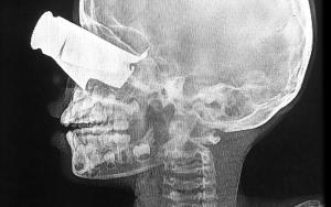 MSF, Doctors Without Borders, Sudan drone attacks 