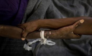 MSF, Doctors Without Borders, Advanced HIV/AIDS 