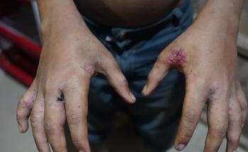 A young child with scabies at MSF’s Hakimpara clinic in Cox’s Bazar, Bangladesh 