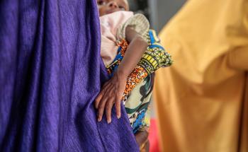 child with severe acute malnutrition in Kofar Marusa therapeutic feeding centre.