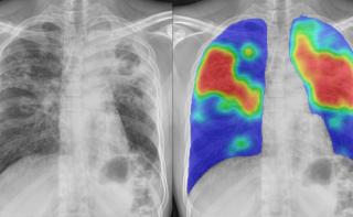 Chest X-ray showing areas identified by CAD4TB artificial intelligence as potentially affected by tuberculosis (TB), with TB later confirmed in the patient.