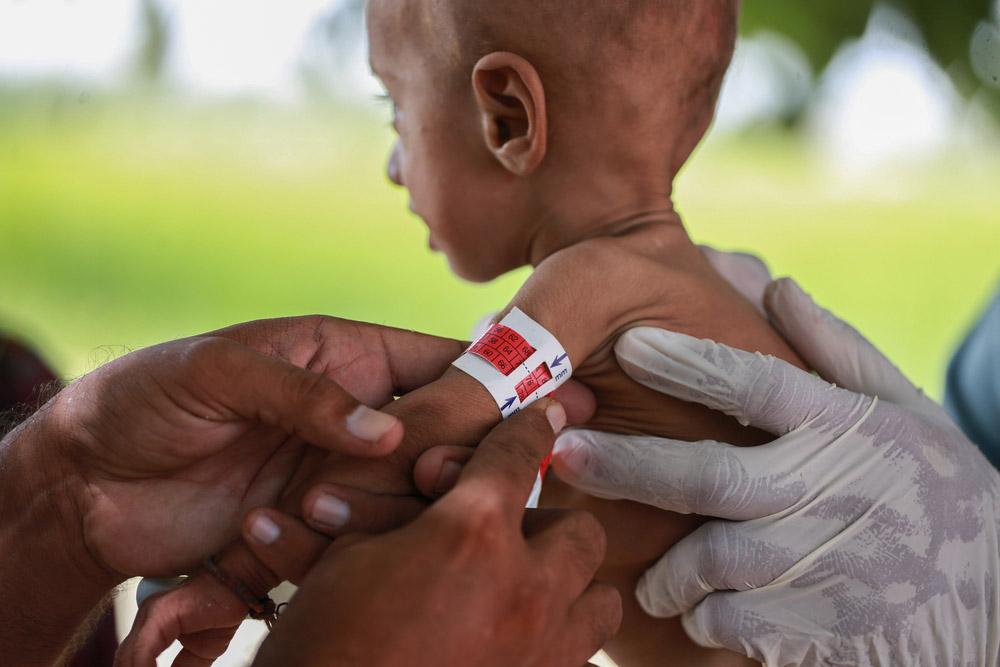 MSF, Doctors Without Borders, Malnutrition 