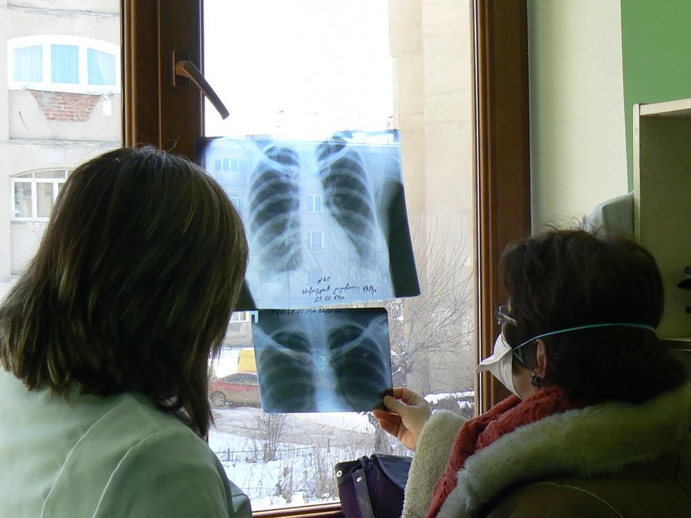 X-rays of a drug-resistant tuberculosis patient. Armenia, February 2014.