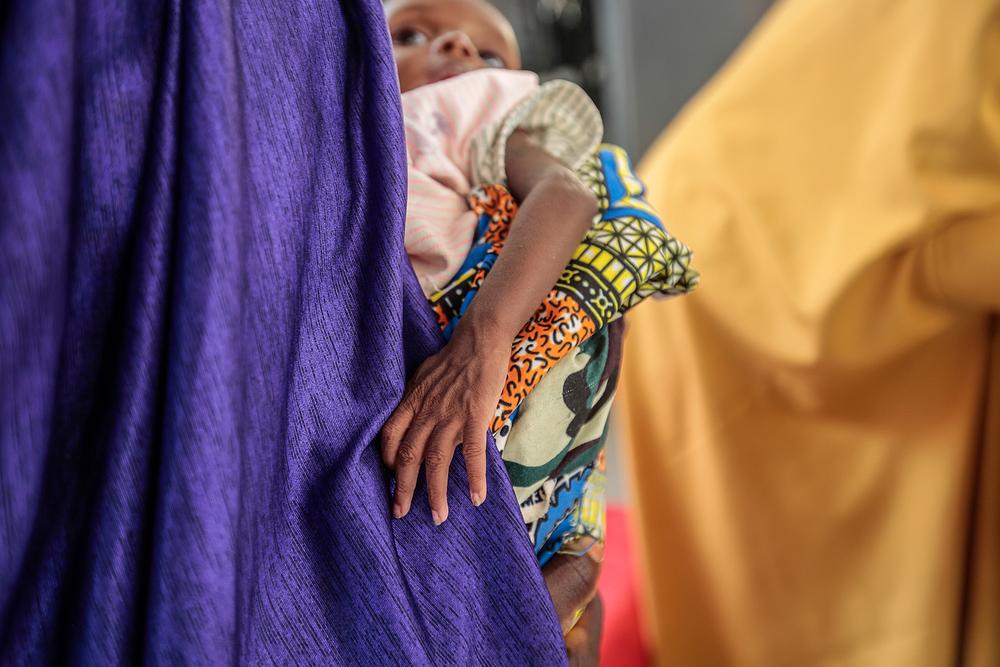 child with severe acute malnutrition in Kofar Marusa therapeutic feeding centre