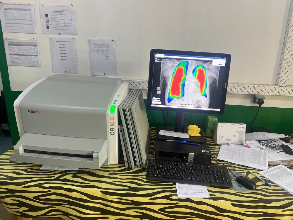 AI tuberculosis screening Central African Republic