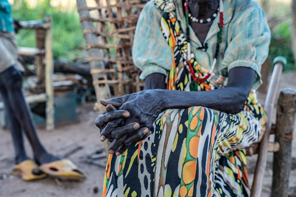 Doctors Without Borders (MSF)_Snakebite Survivor 