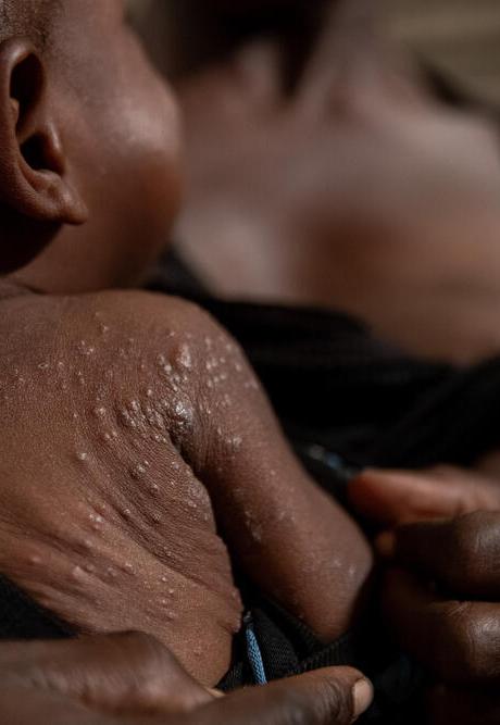 A baby is screened for mpox as a doctor examines his back.