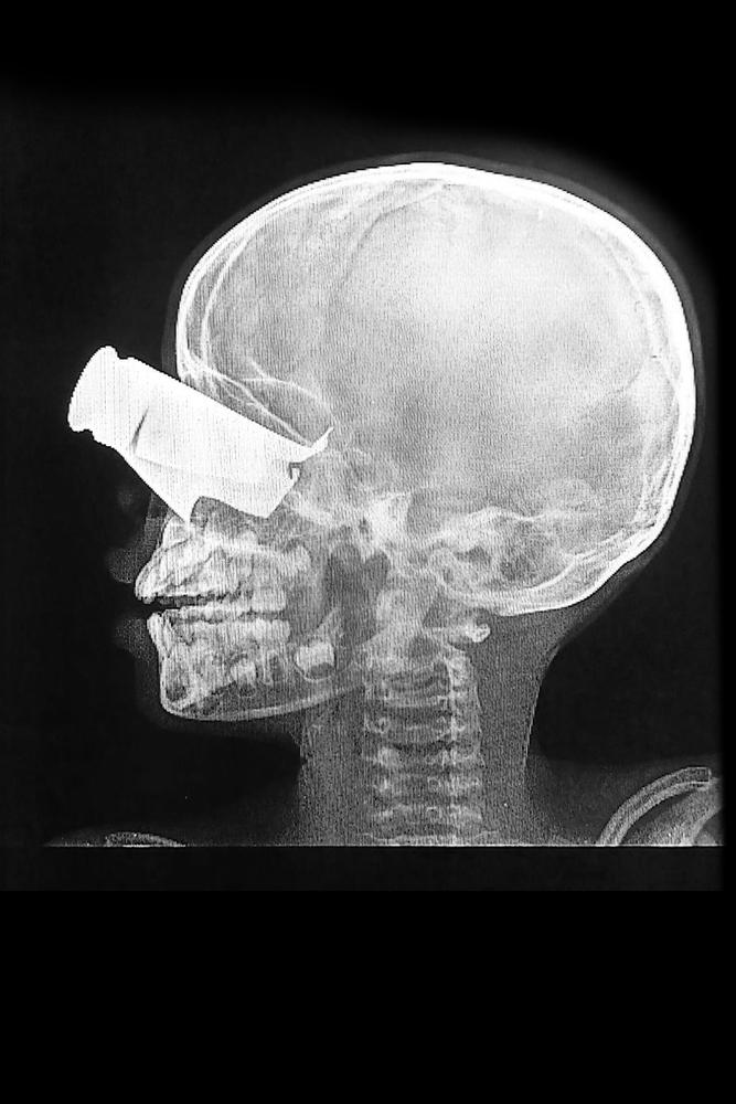 MSF, Doctors Without Borders, Sudan drone attacks 