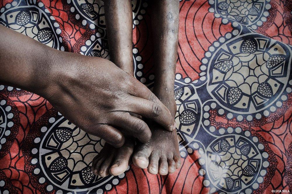 Msf206635 Malawi