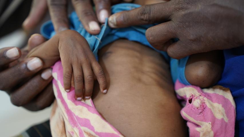 MSF, Doctors Without Borders, Funding gaps, Somalia, Women and Children