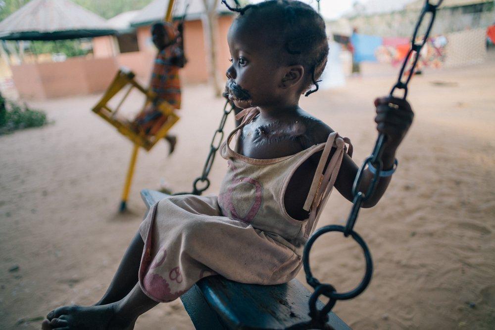 A little girl who was affected by Noma swings in a dusty playground.